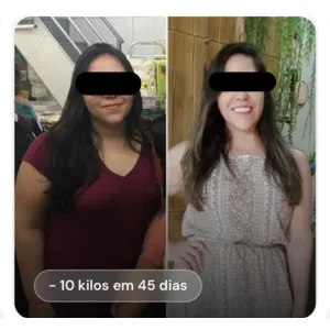 Resultado antes e depois de paciente (rosto preservado): -10 kg em 45 dias