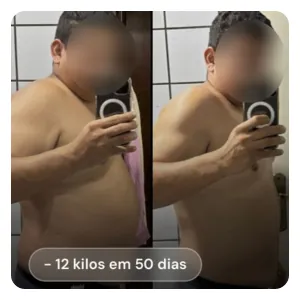 Resultado antes e depois de paciente (rosto preservado): -12 kg em 50 dias